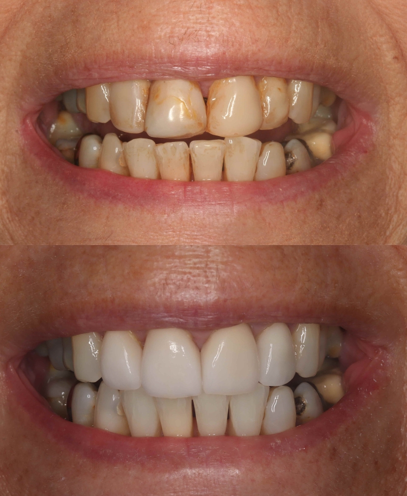 Veneers Rabbett