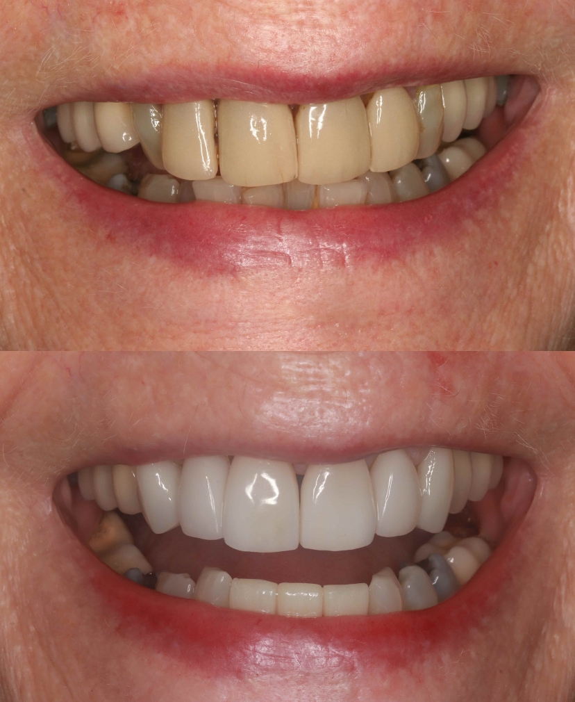 Veneers Outing
