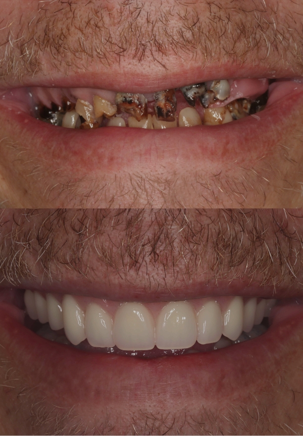 Veneers