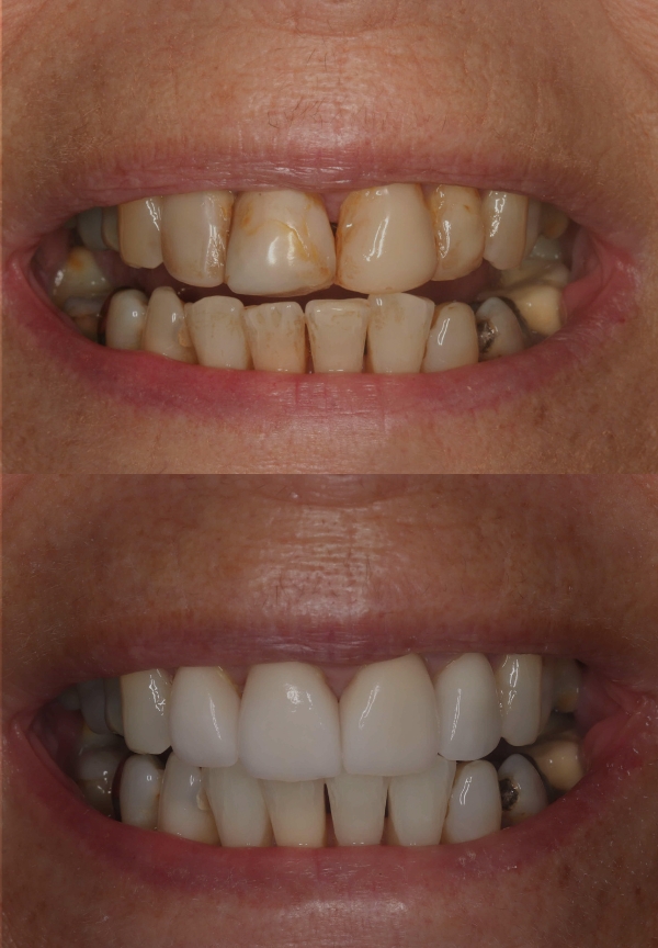 Porcelain Veneers
