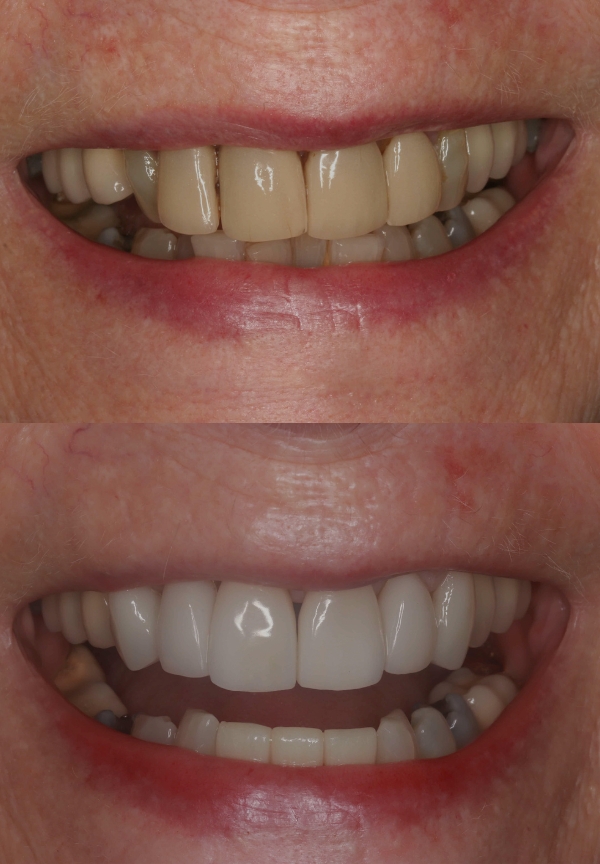 Porcelain Veneers