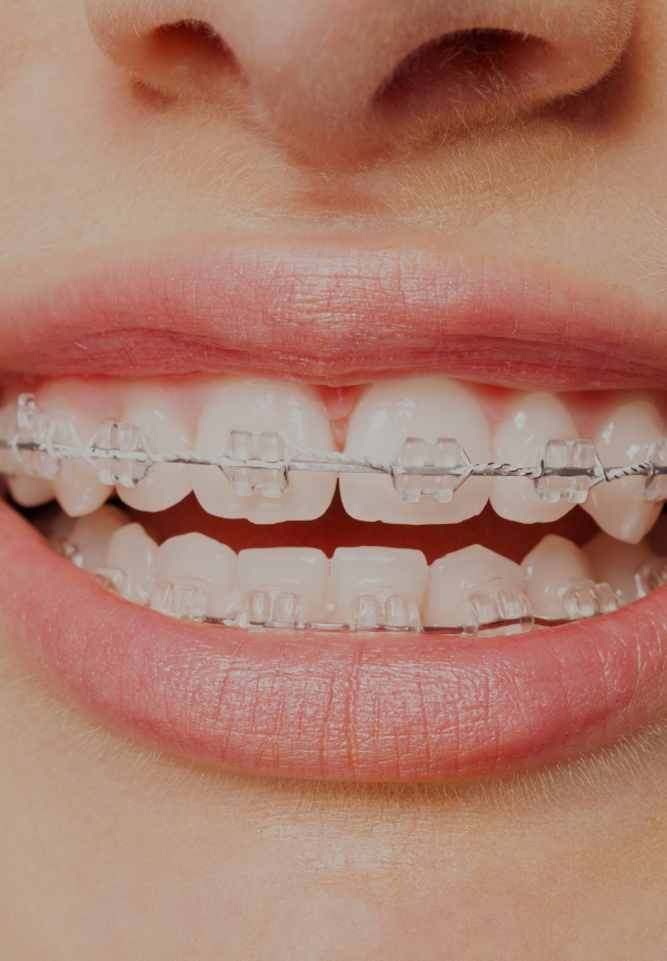 Treatment -  The Observatory Dental