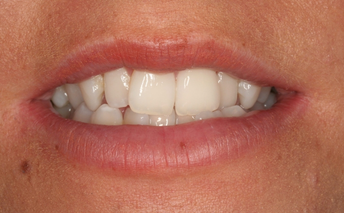 Invisalign® before