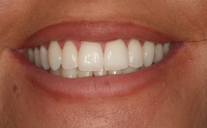 Invisalign® after