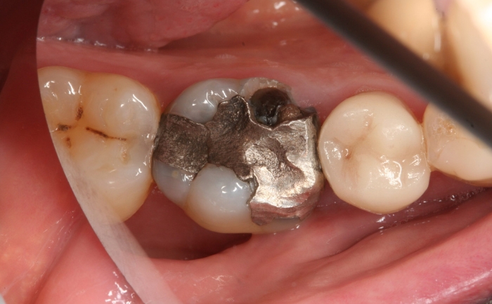 Porcelain filling onlay before