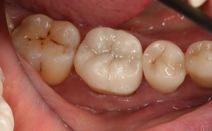 Porcelain filling onlay after