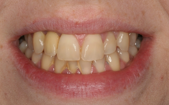 Teeth Whitening before