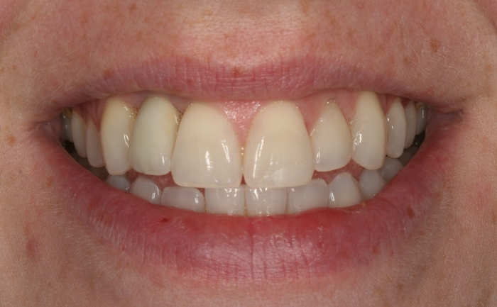 Teeth Whitening after