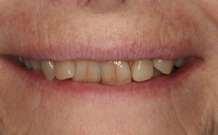 Smile Makeover before