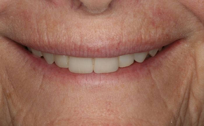 Smile Makeover after