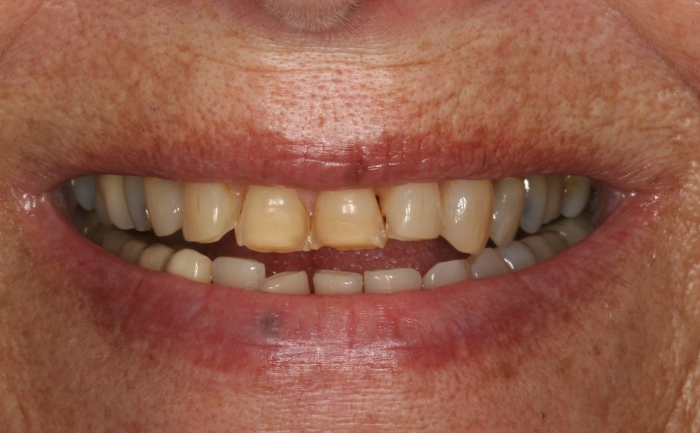 Porcelain Veneers before