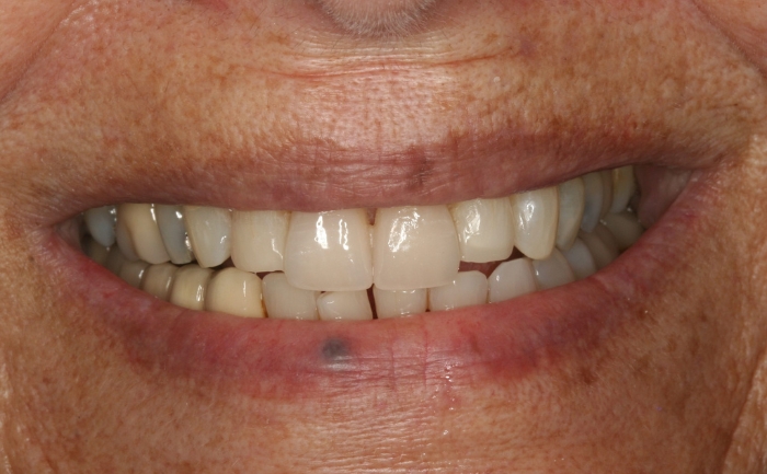Porcelain Veneers after