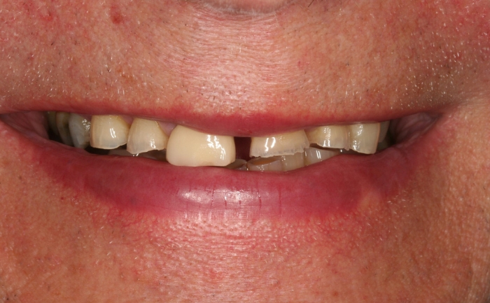 Composite Bonding before