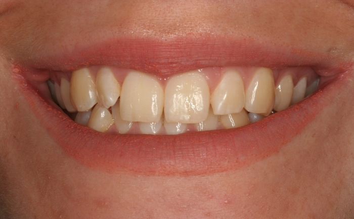 Smile Makeover before