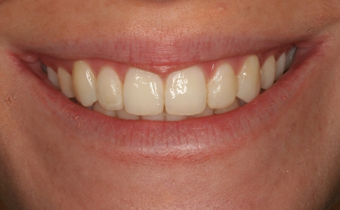 Smile Makeover after