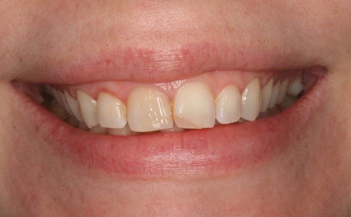 Smile Makeover before