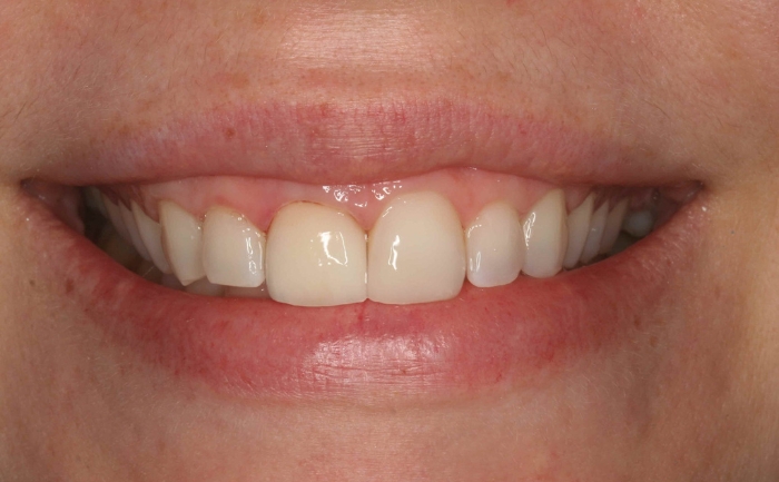 Smile Makeover after