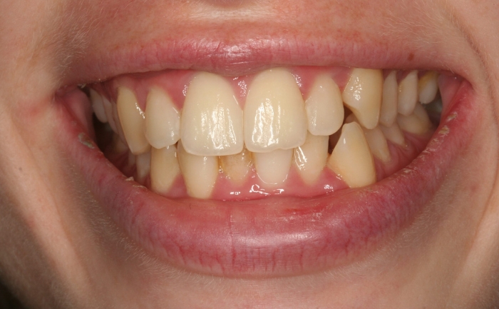 Smile Makeover before