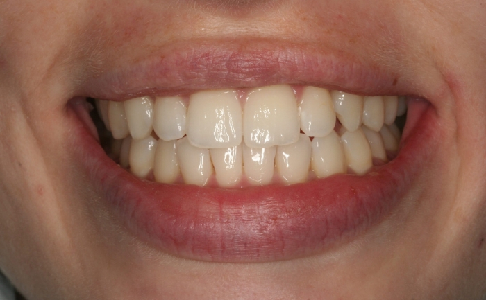 Smile Makeover after