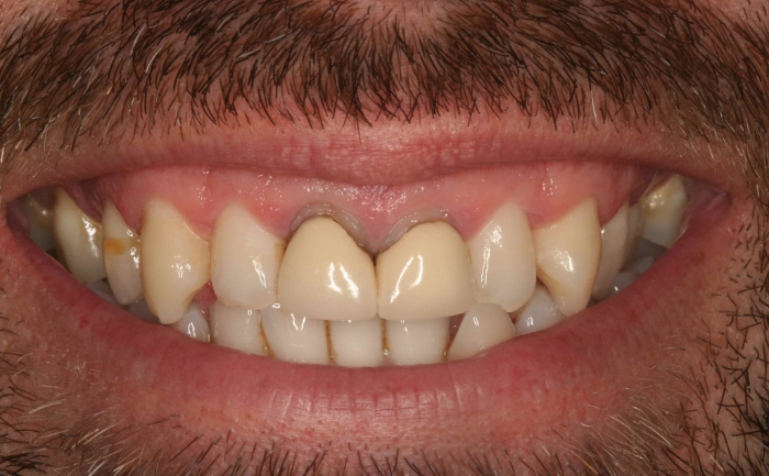 Porcelain Veneers before