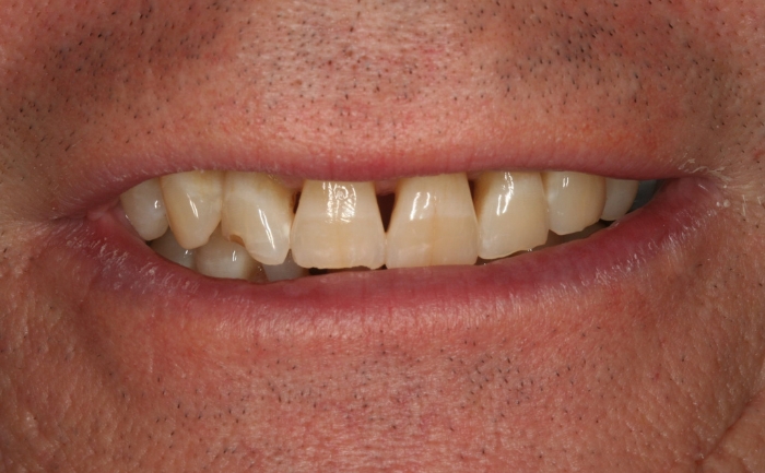 Porcelain Veneers before