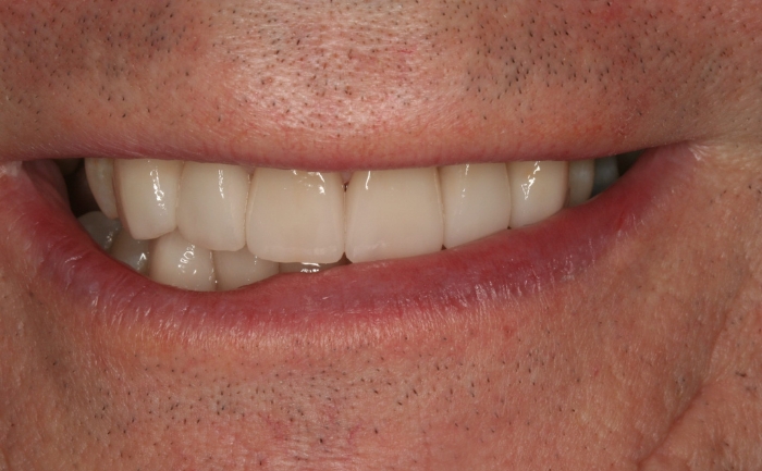 Porcelain Veneers after