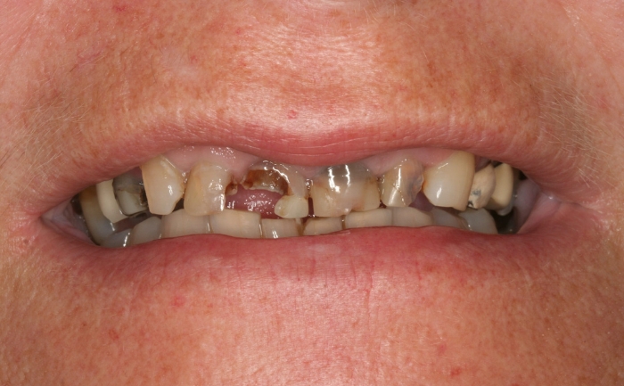 Cosmetic Dentures
