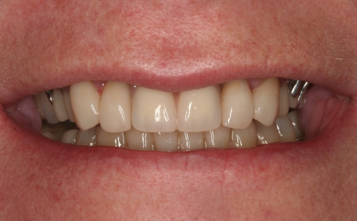 Cosmetic Dentures after