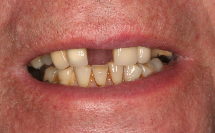 Dental Implants before