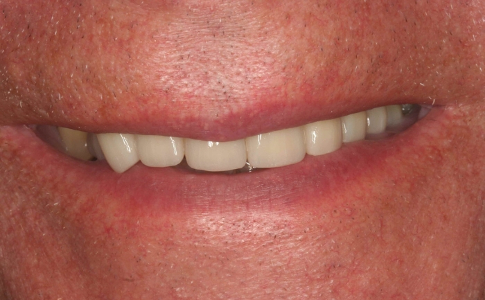 Dental Implants after