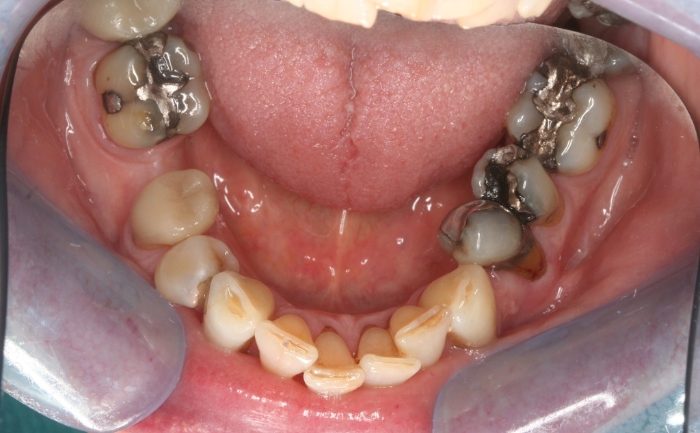 Amalgam Filling Removal before