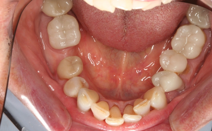 Amalgam Filling Removal after