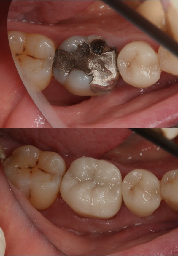 Inlays and onlays