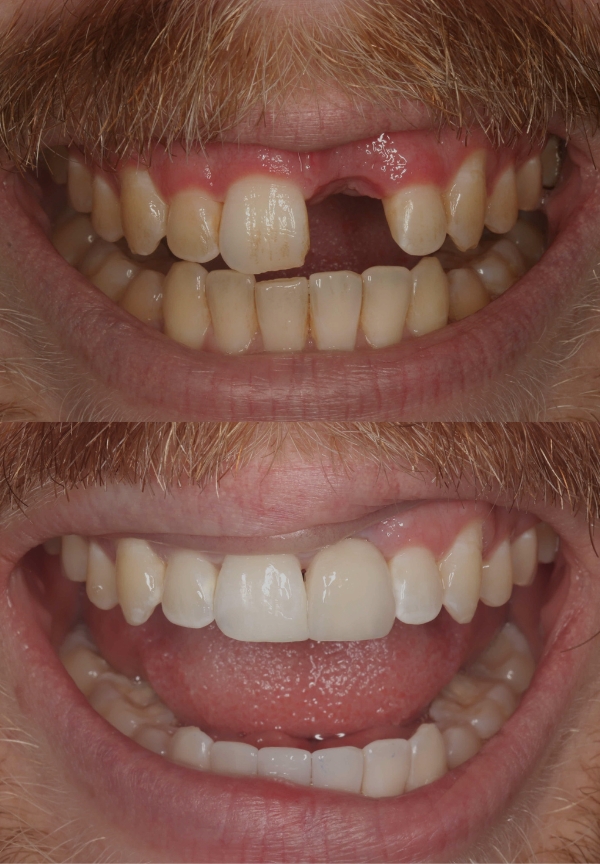 Missing Teeth