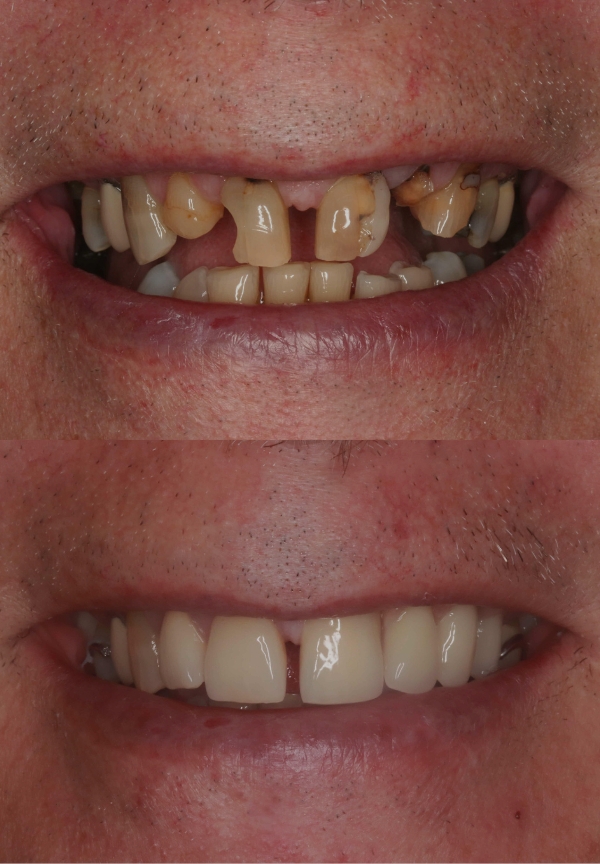 High Aesthetic Low Profile Dentures