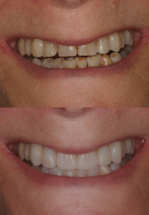 Tooth Wear