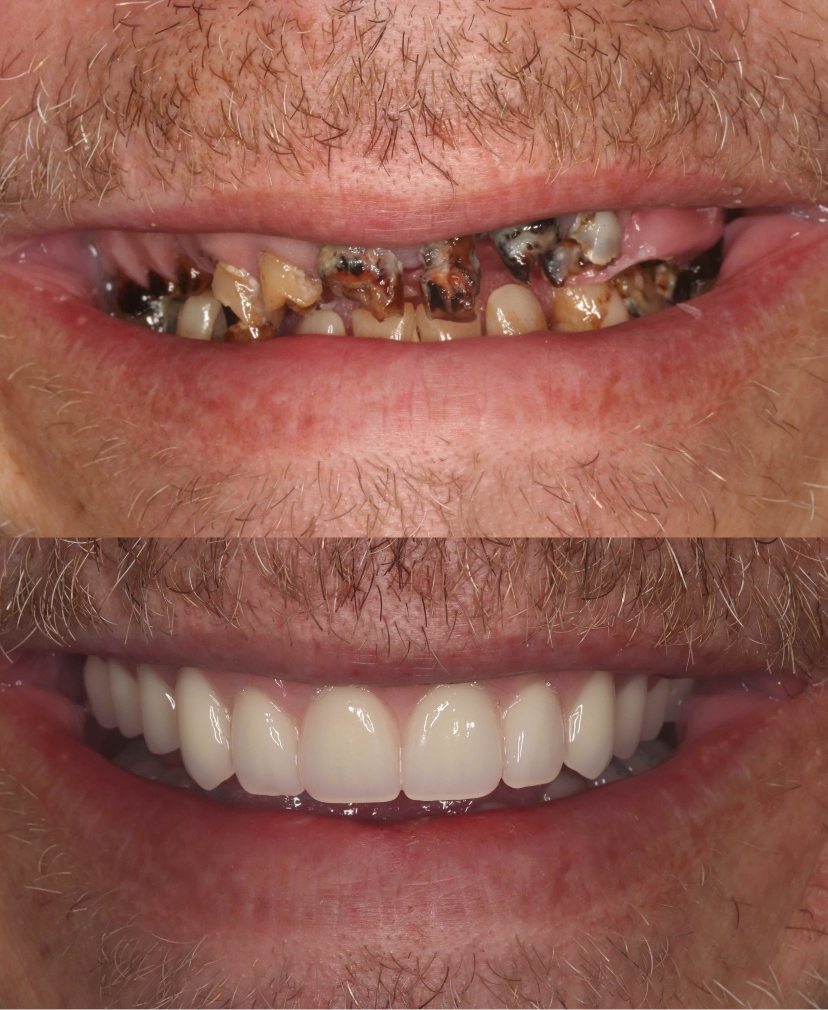 All-on-Four & All-on-Six Dental Implants