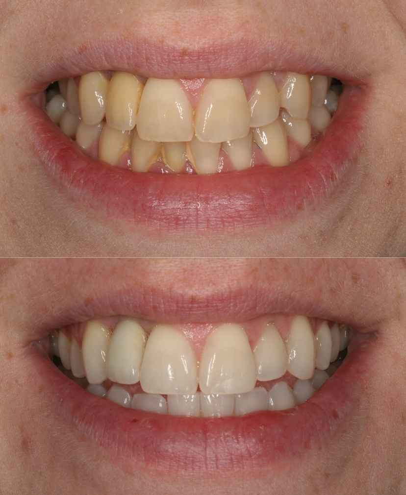 Teeth Whitening