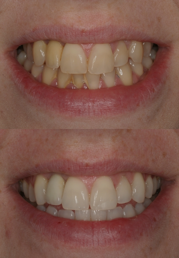 Teeth Whitening