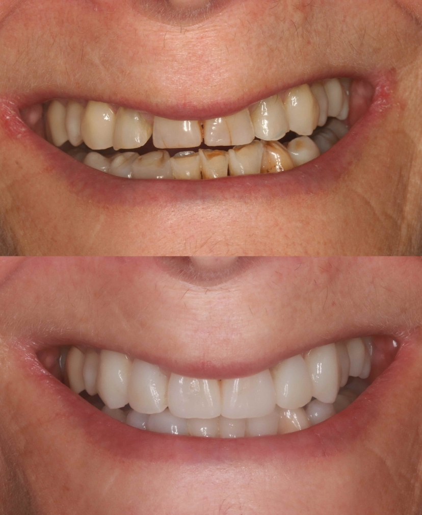 Composite Bonding