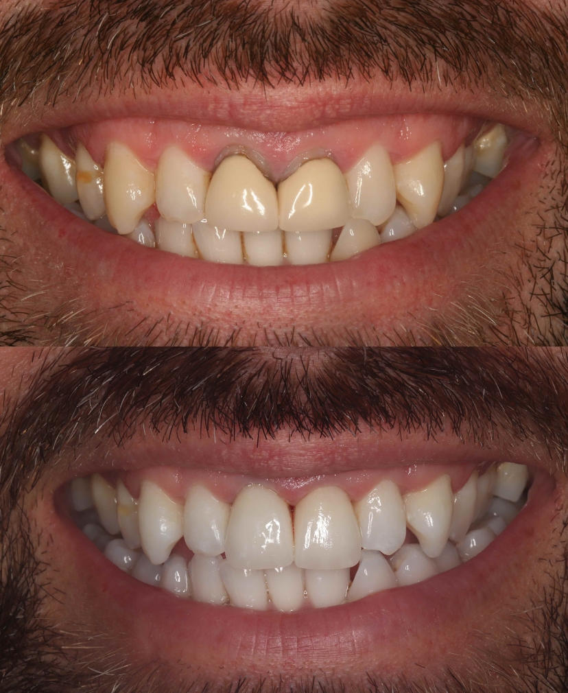 Smile Makeover