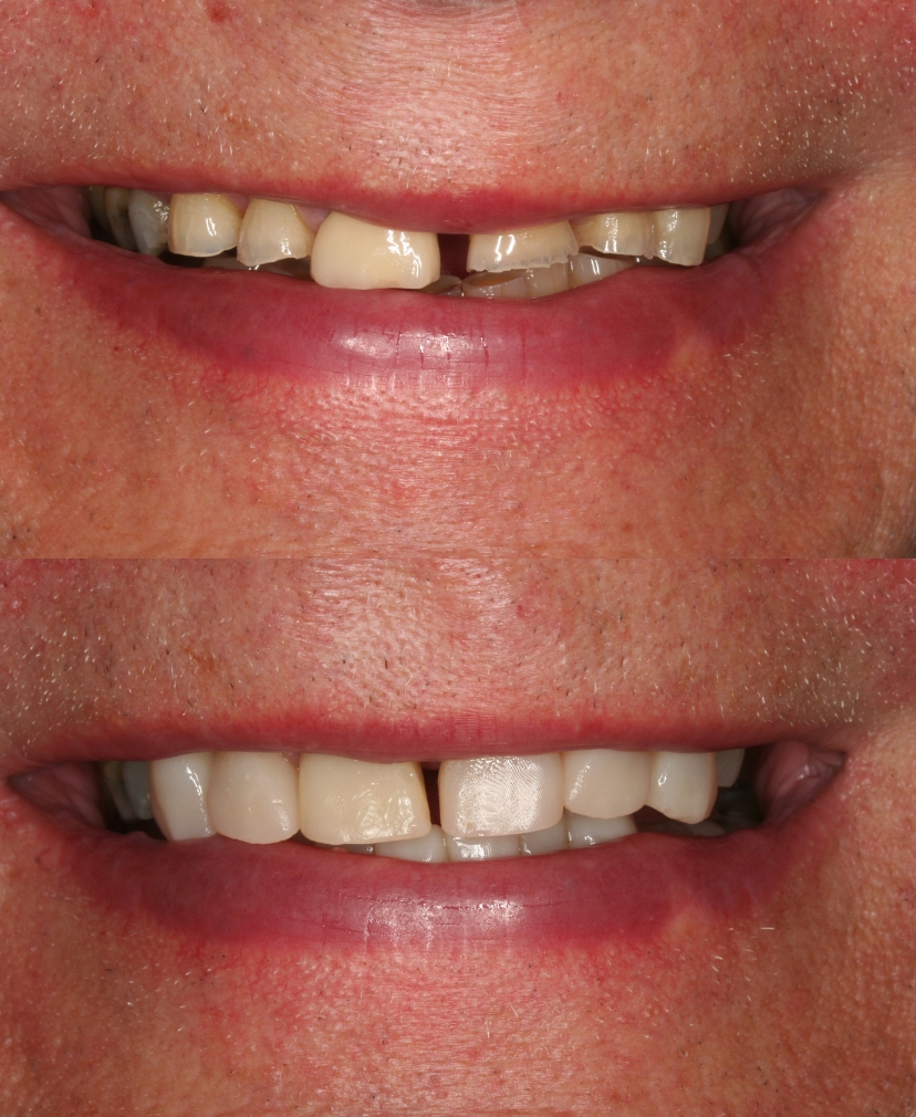 Composite Bonding