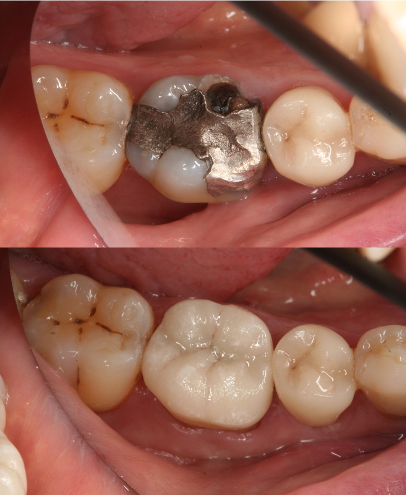 Tooth Rejuvenation