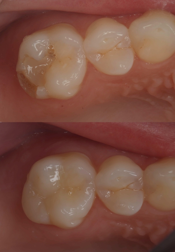 White Fillings
