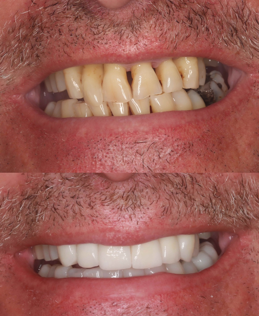 Veneers Outing