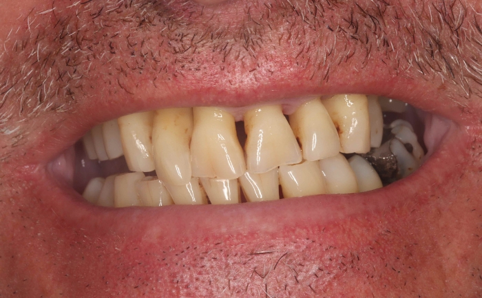 Porcelain Veneers Case 1 before