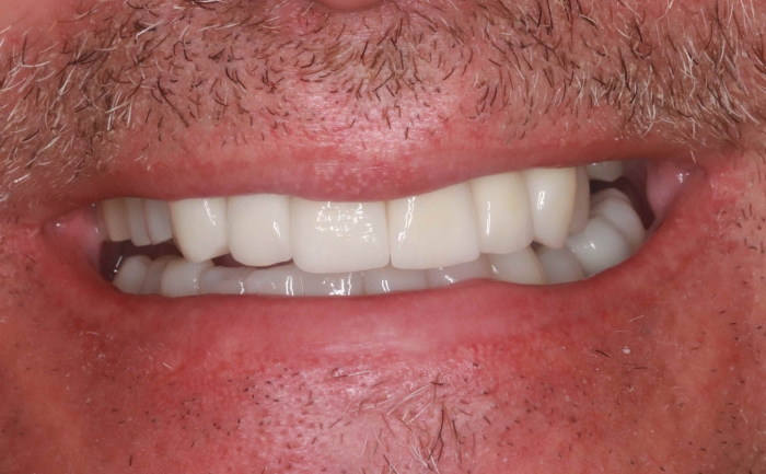 Porcelain Veneers Case 1 after