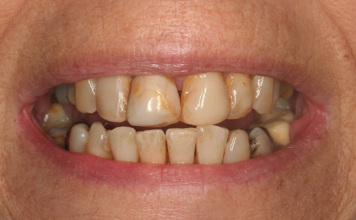 Porcelain Veneers - Case 2 before