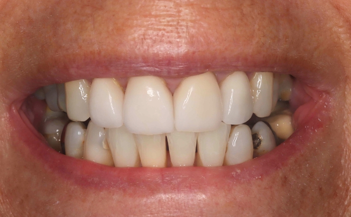 Porcelain Veneers - Case 2 after