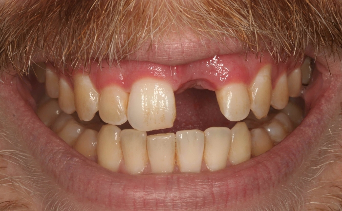 Dental implants - Case 1 before
